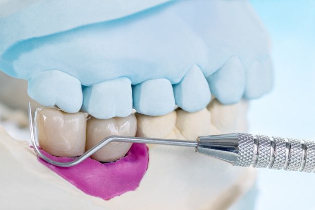 Dental Implants in Moston: What You Need to Know