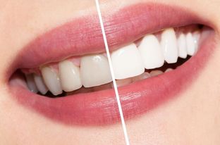 Some Pros And Cons Of Teeth Whitening 