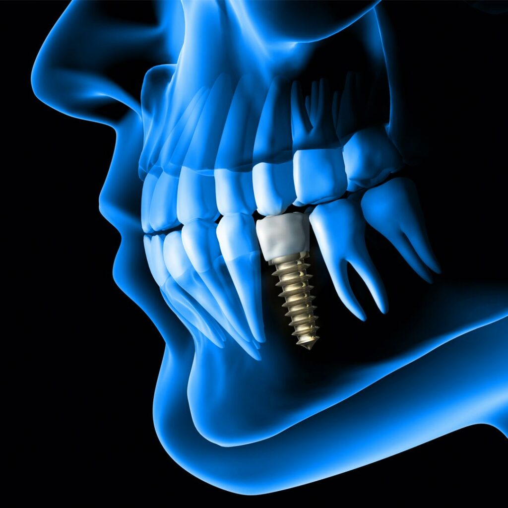 Transform Your Smile at the Best Dental Implant Clinic in Dubai
