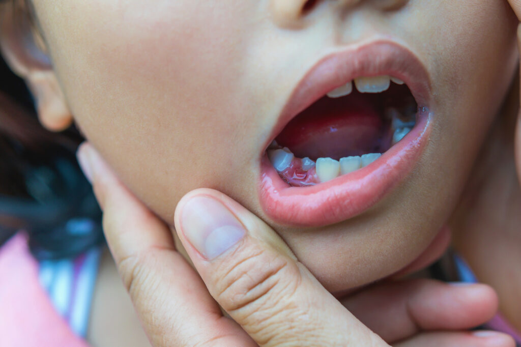 My Kid Chipped a Tooth: Heres What to Do Next