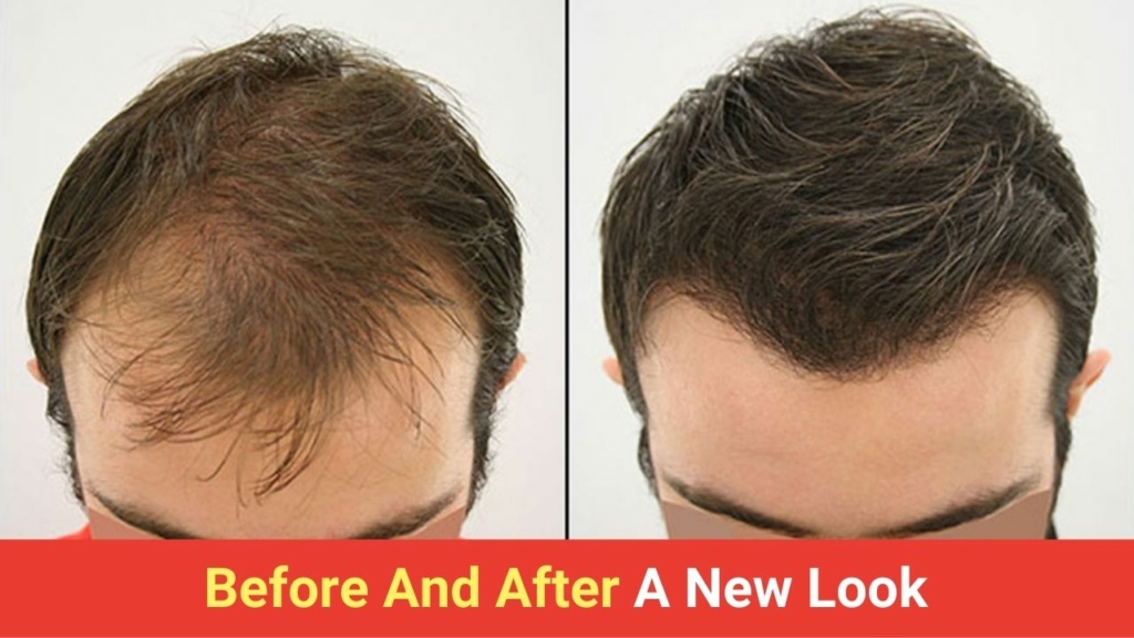  A Comprehensive Guide to Transform Your Look with Hair Transplant