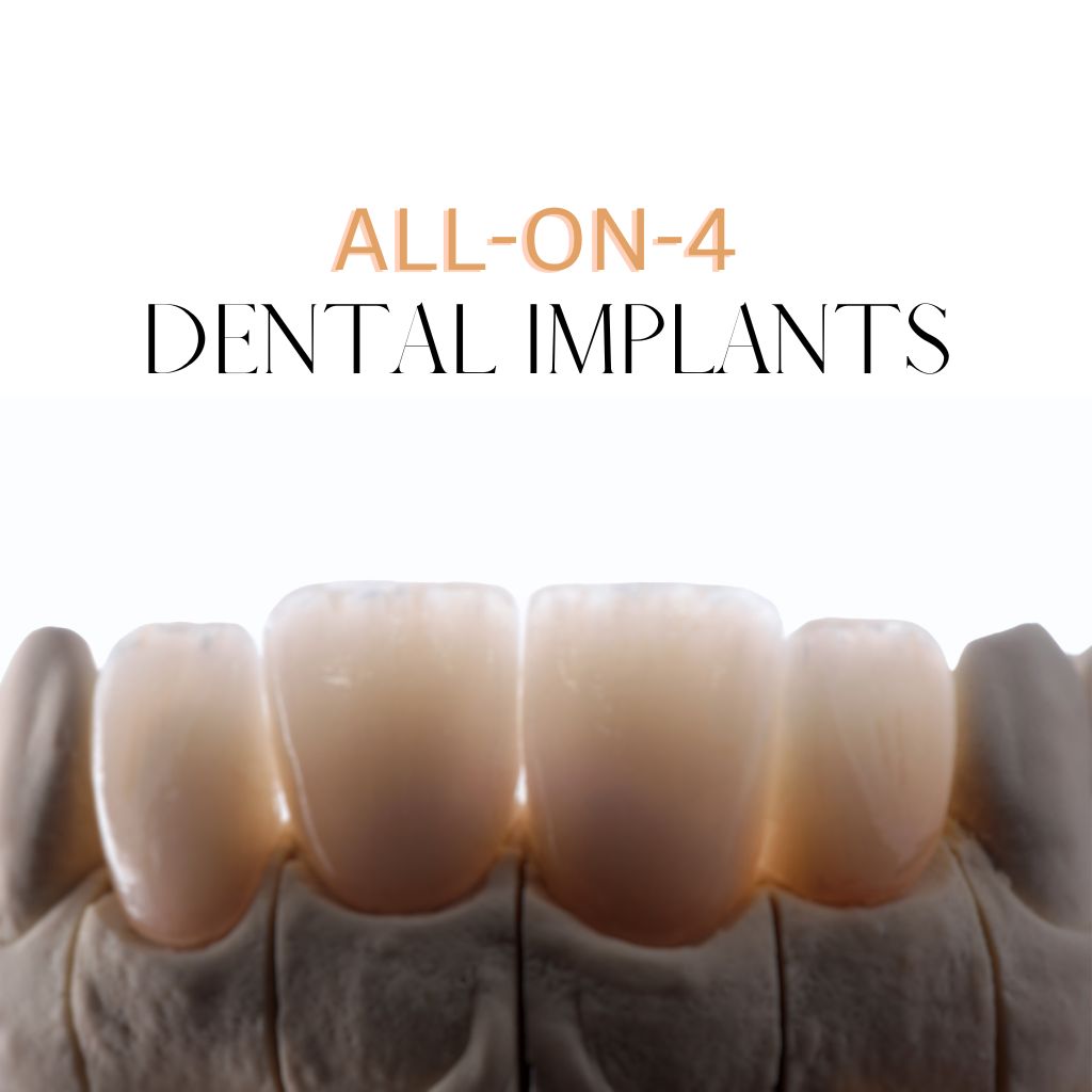 All-on-4 Dental Implants​: A Permanent Solution for Missing Teeth
