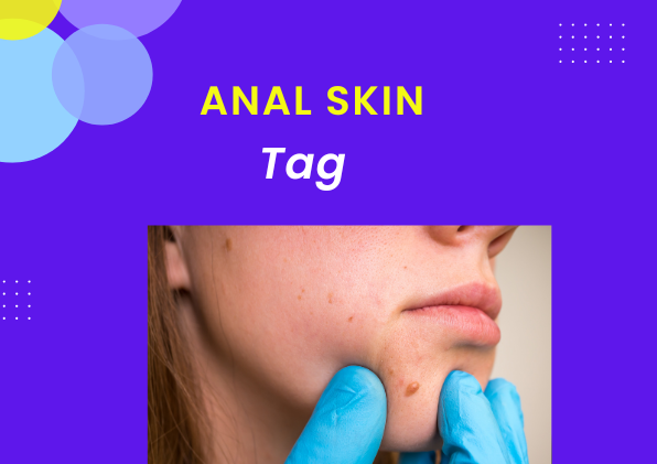 anal skin tag causes