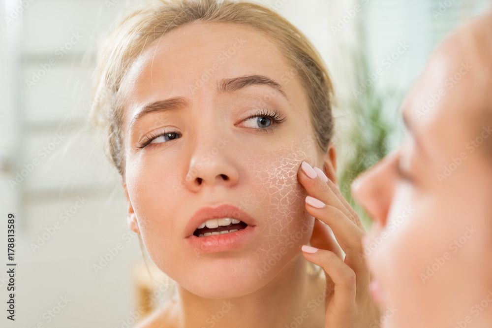 does moisturizer cause acne