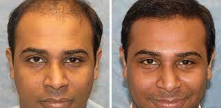 Involved in a Hair Transplant Procedure