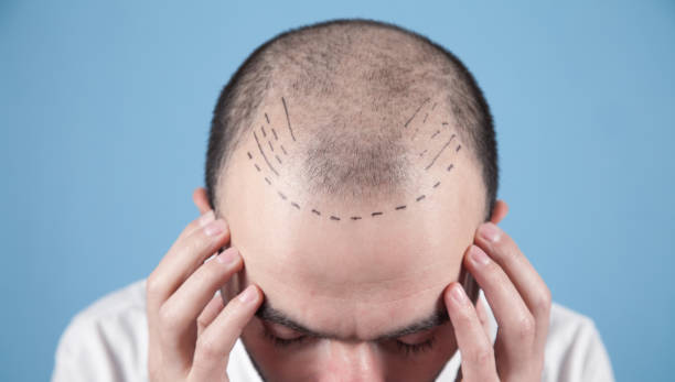 Who Is A Good Candidate for A Hair Transplant In Turkey?