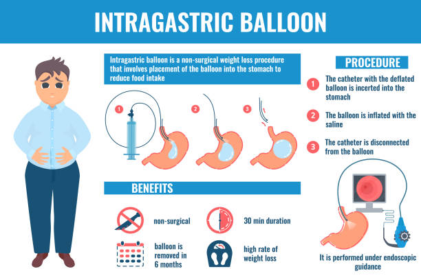 balloon treatment for weight loss