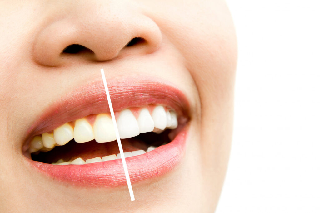 How to Get a Brighter Smile with Teeth Whitening in Pennsylvania