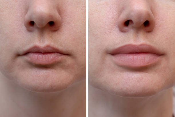 Lip Filler Before and After in Tucson