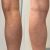 Stop Ignoring Leg Heaviness: How to Identify and Treat Chronic Venous Insufficiency