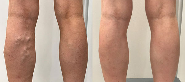 Stop Ignoring Leg Heaviness: How to Identify and Treat Chronic Venous Insufficiency