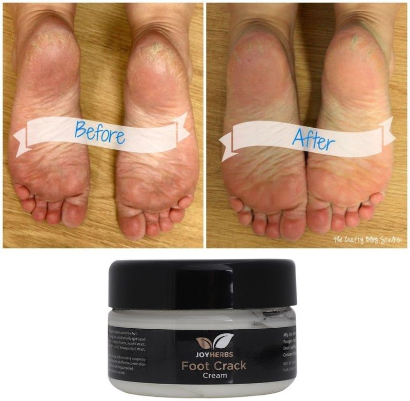 JOYHERBS Foot Crack Cream Cracked Skin, Heel  (50 g)