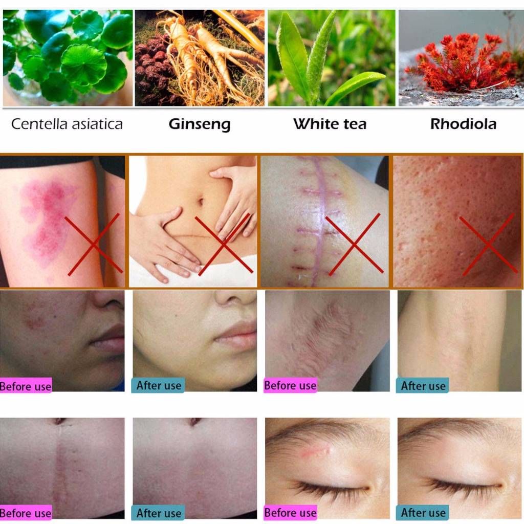 LanBeNa Acne Scar Removal Cream