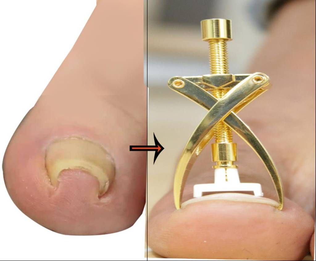 Nail Repair