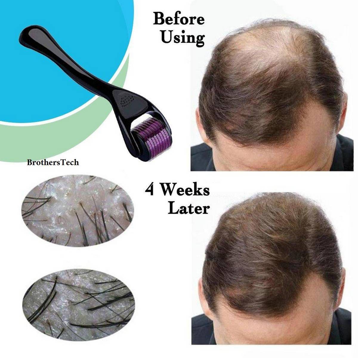 Fair Fall Solution Derma Roller 0.5 Mm For New Hair Growth - Hair Clip