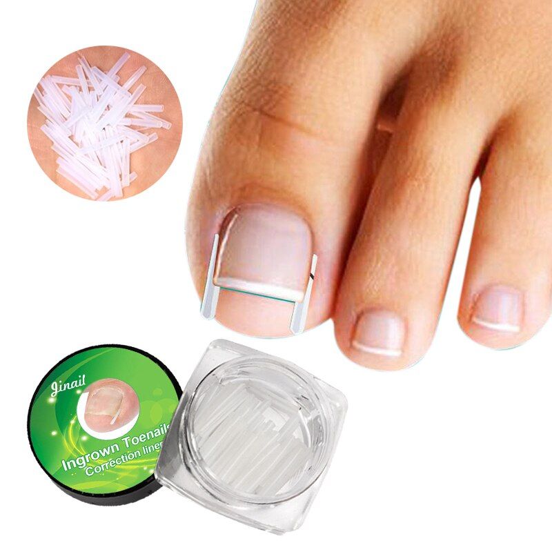 10-Piece Nail Pad Inlay Nail Infilled Pad Nail Groove Pad Onyxis Corrector Inlay Nail Toenail Straightening Sticker Nail Silk