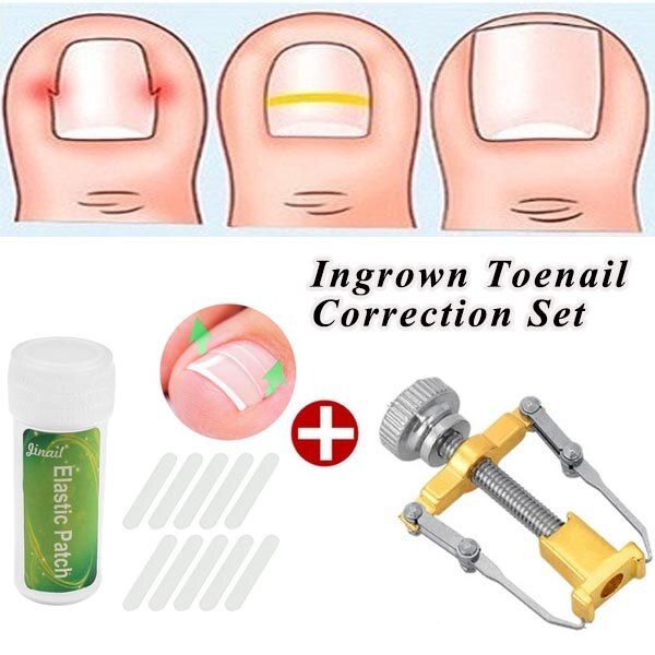 1PC Stainless Steel Ingrown Toe Nail Correction Tool +10Pcs Nail Correction Patch Nails Art Equipment Tool