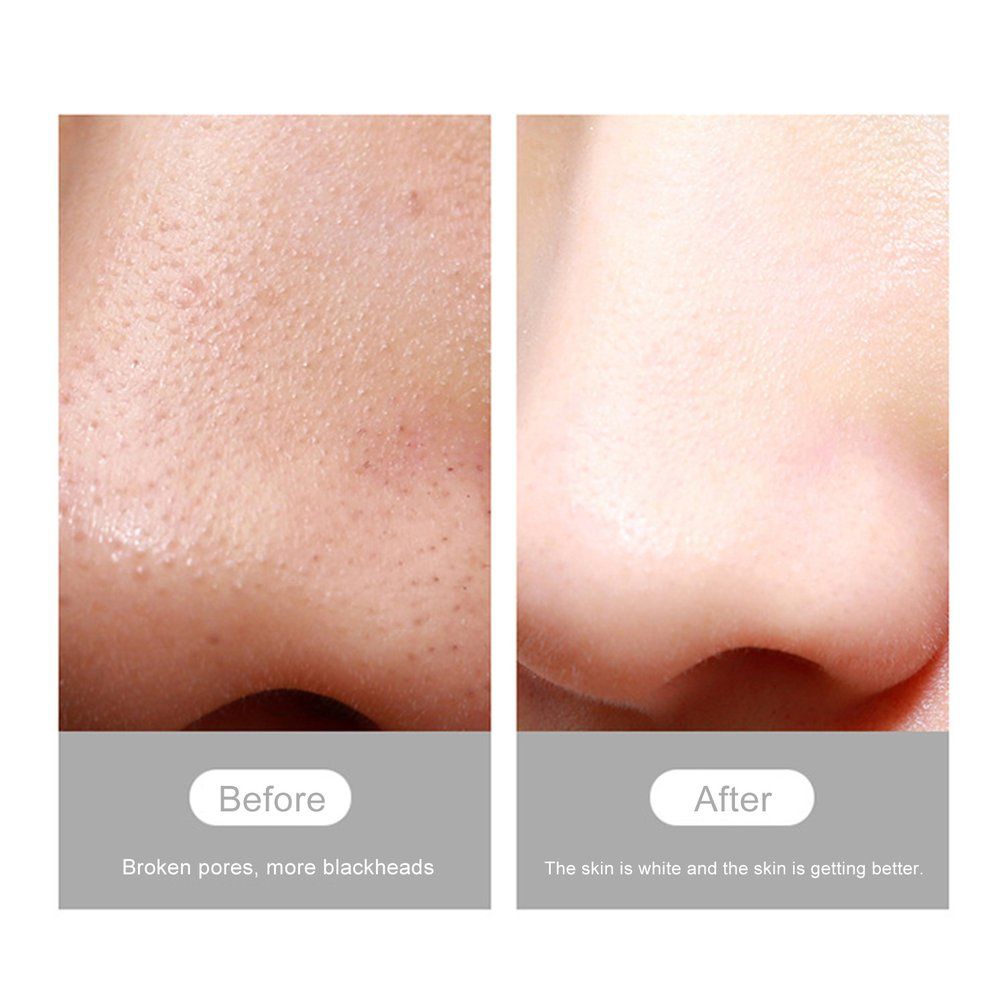 USB Rechargeable Visual Blackhead Remover Facial Pores Black Head Cleaner - white