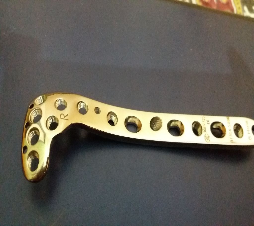 Proximal lateral Tibial with Locking plate 3.5mm