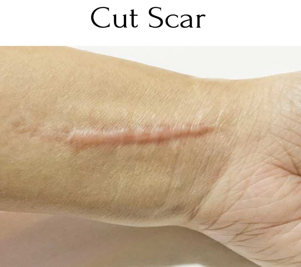 Anti Scar & Stretch Marks Cream || Made In Thailand