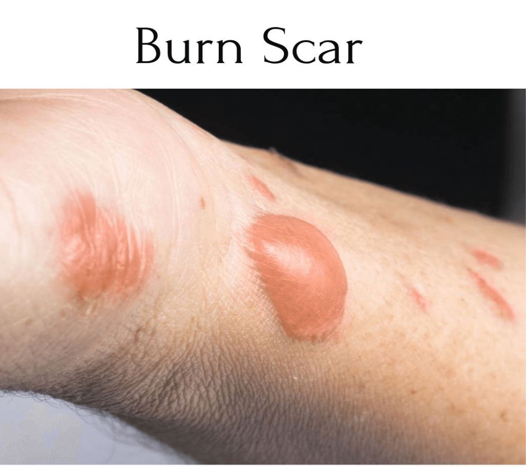 Burn Scar Removal Cream