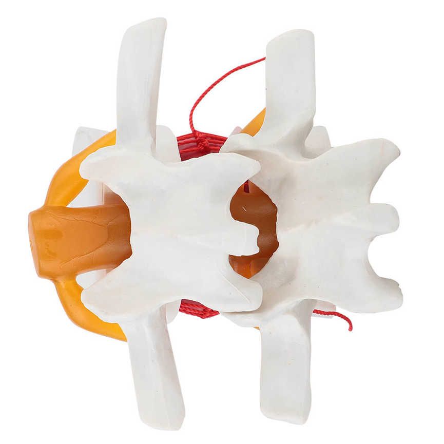 1:1.5 Medical Demonstration Model Of Lumbar Vertebral Spine Human Disc Herniation