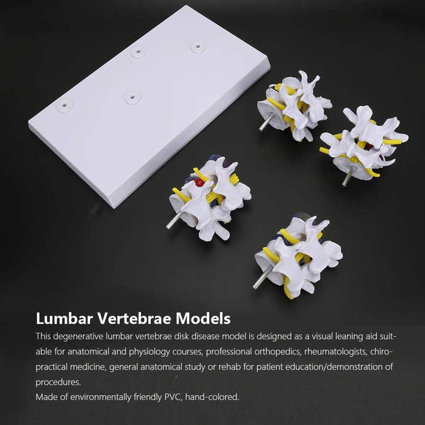 Human Lumbar Vertebrae 4-stage Medicals Combination of Normal and Pathological Models