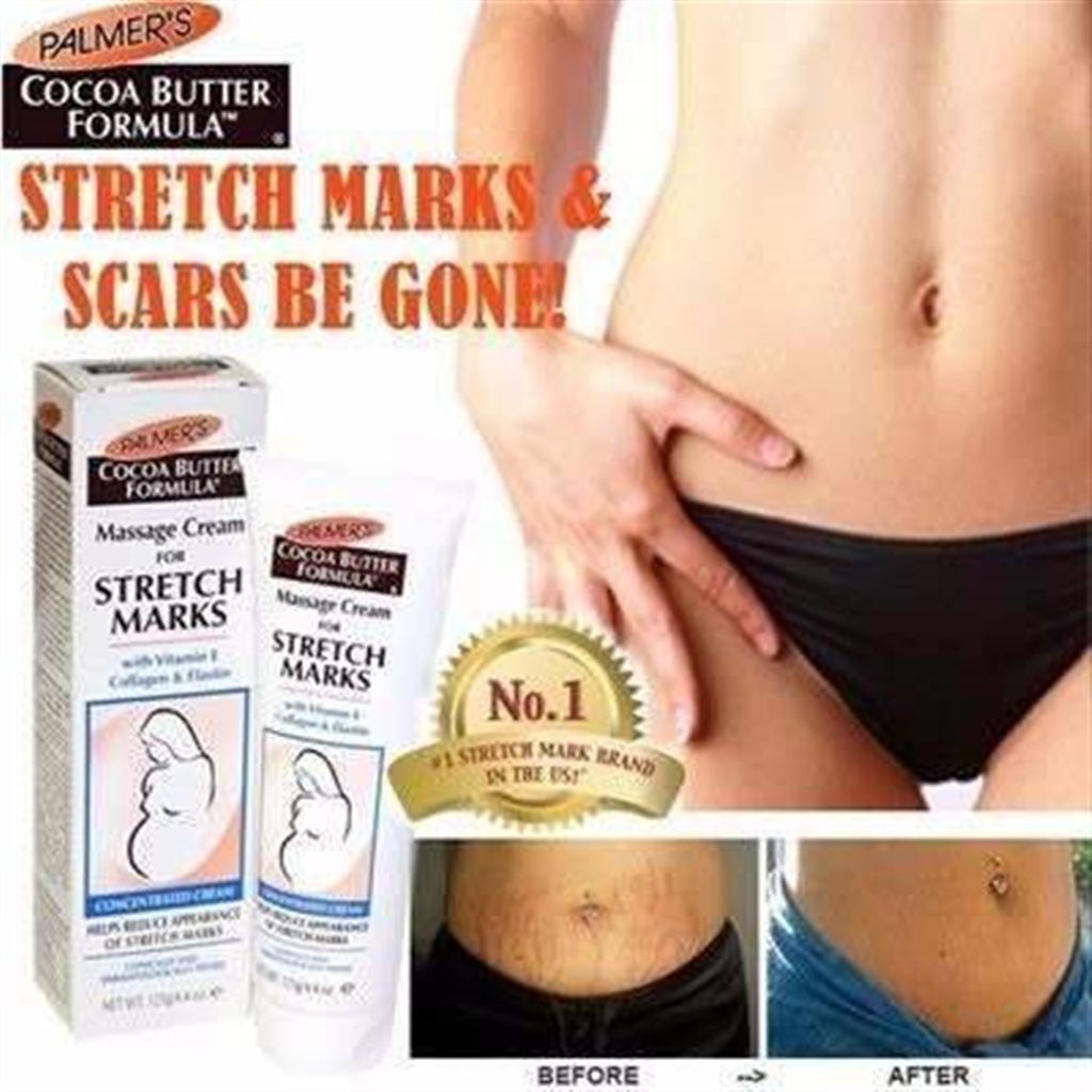 STRETCH MARKS