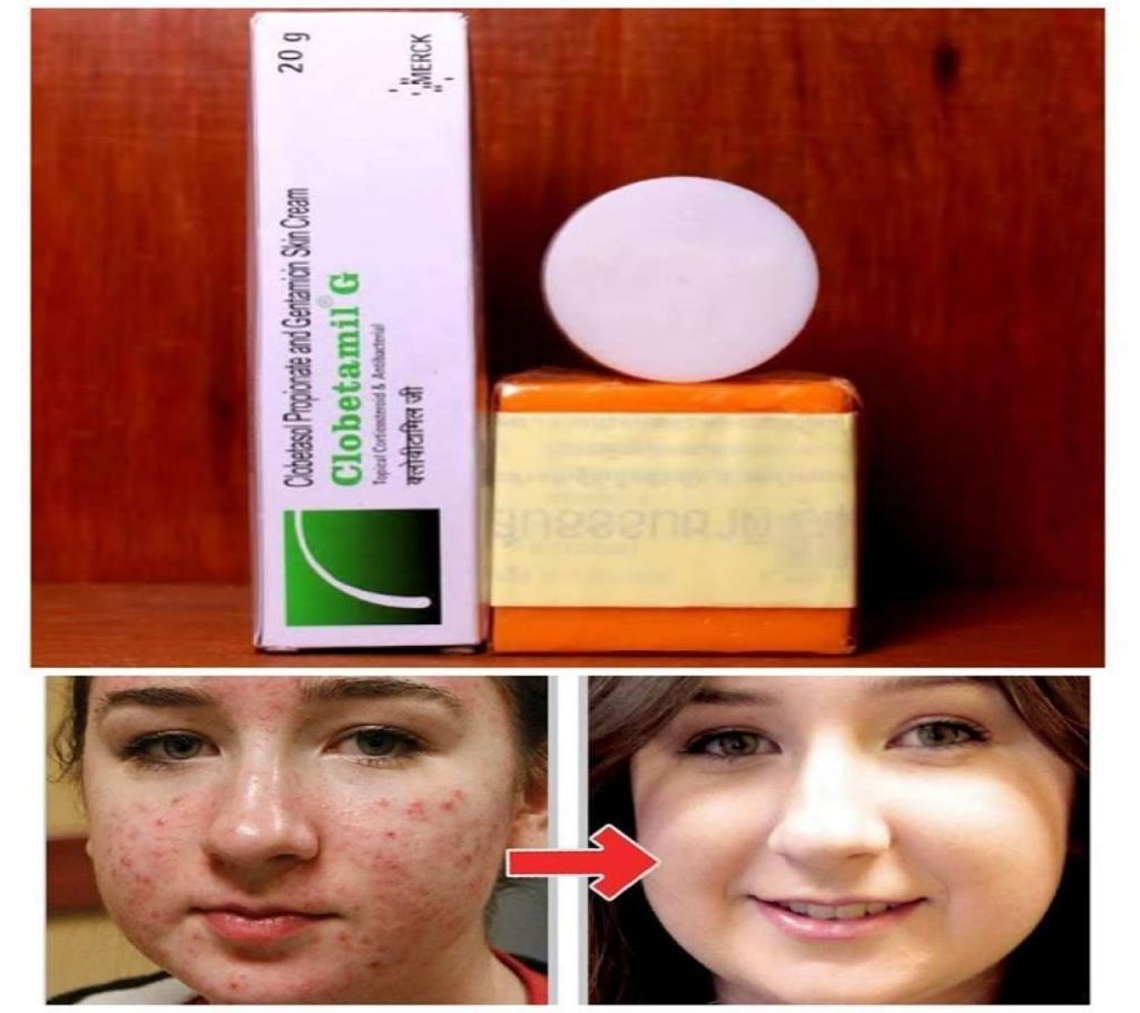 New Clobetamil G Skin Soap and Cream Set